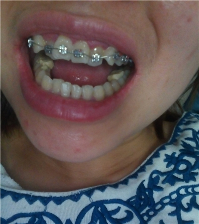 成都圣貝口腔翟永森做的牙齒矯正，分享果照片~